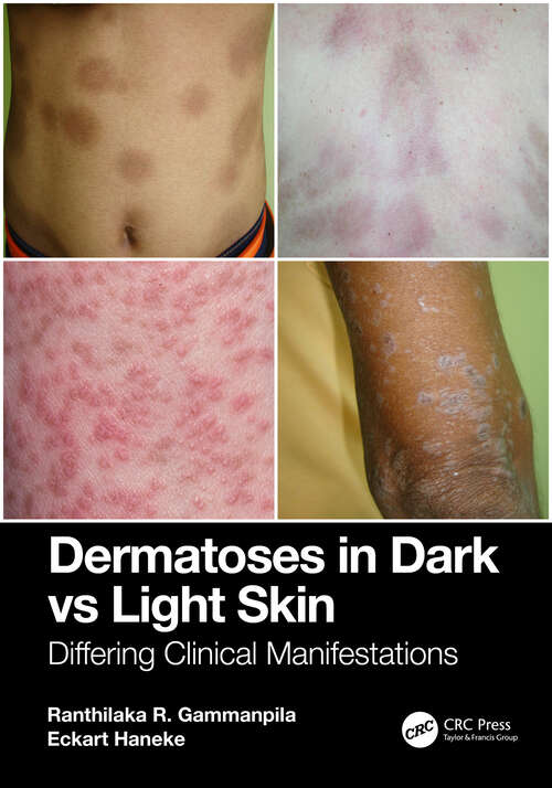 Book cover of Dermatoses in Dark Vs Light Skin: Differing Clinical Manifestations (1)