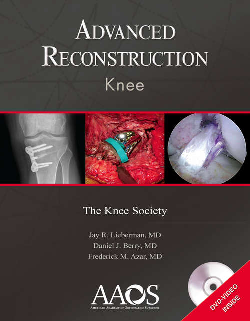 Advanced Reconstruction: Knee (Advanced Reconstruction Ser.)