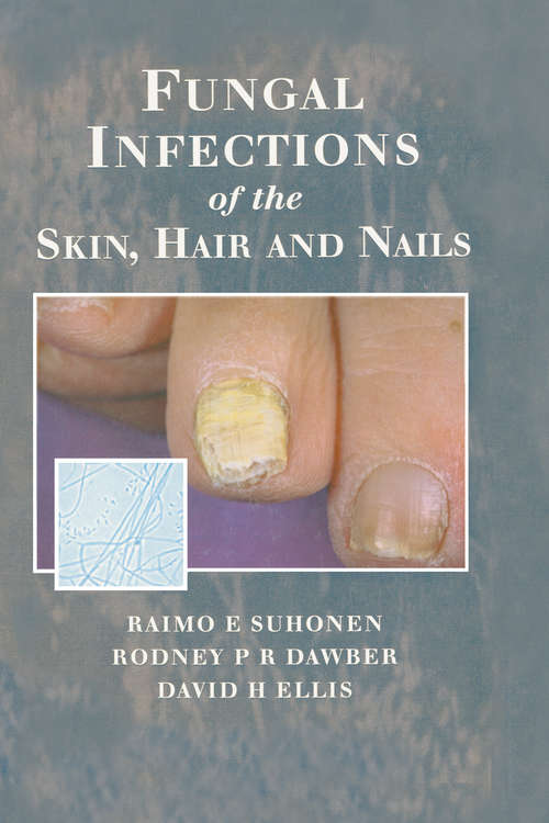 Fungal Infections of the Skin and Nails
