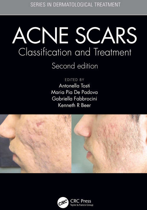 Acne Scars: Classification and Treatment, Second Edition (Series in Dermatological Treatment)