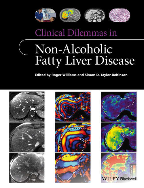 Clinical Dilemmas in Non-Alcoholic Fatty Liver Disease