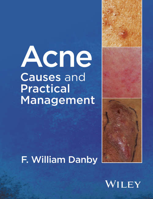 Book cover of Acne