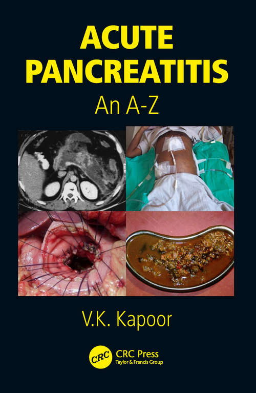 Acute Pancreatitis: An A-Z