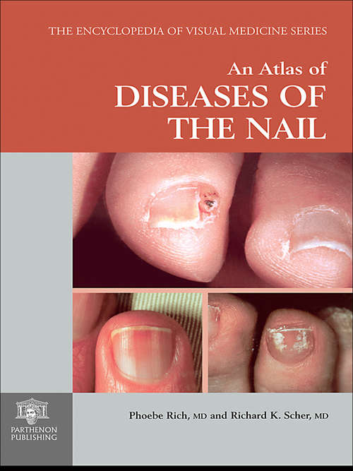 An Atlas of Diseases of the Nail (The\encyclopedia Of Visual Medicine Ser.)